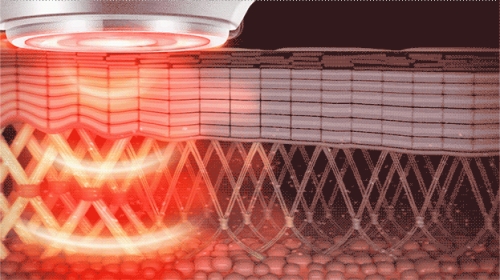 什么是频谱理疗仪好几千块的射频美容仪能抗衰老吗？_https://www.jmylbn.com_新闻资讯_第2张