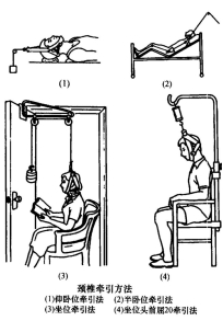 颈椎牵引的正确示意图图片