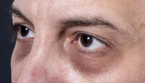 色素型黑眼圈,主要是由于眶周皮肤内黑色素,或黑素细胞增多,导致的